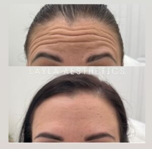 Botox in Bolton – What to Expect Before and After