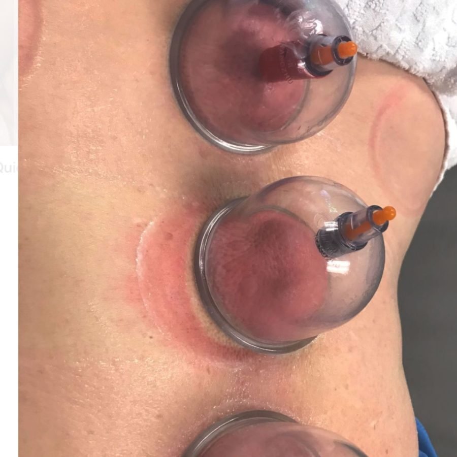 cupping: Hajjama near me