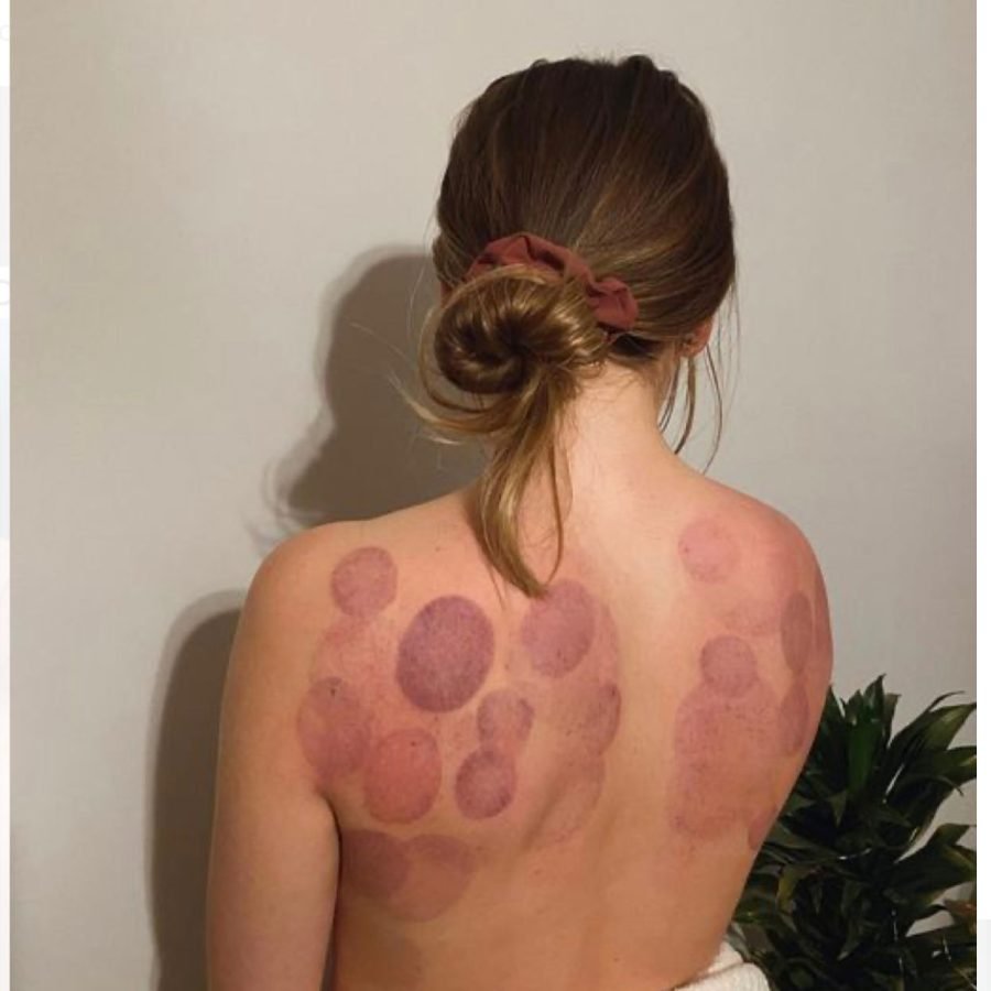 result cupping 1